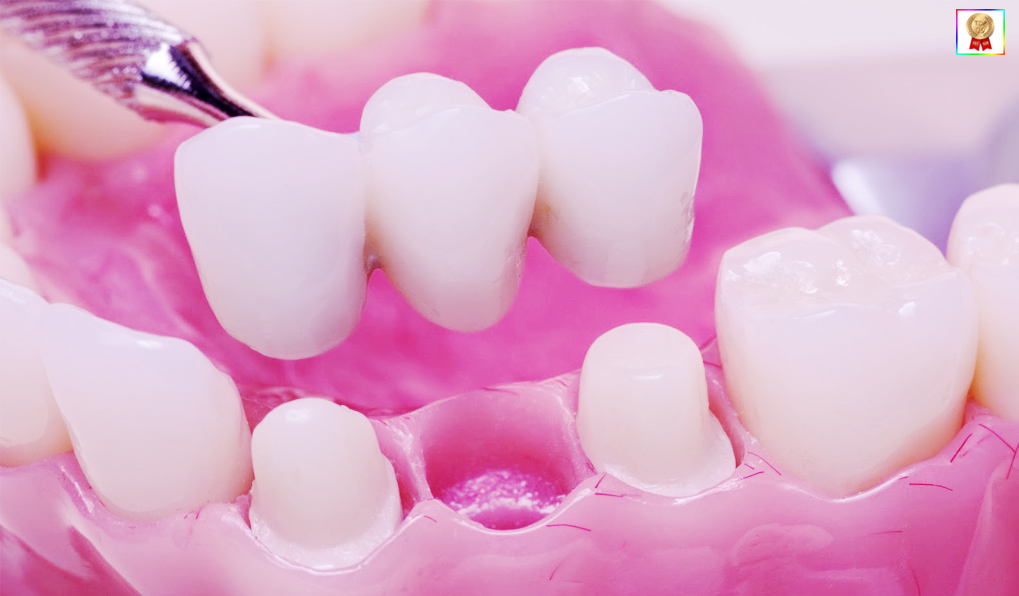 Phương pháp trồng răng làm cầu sứ răng giả